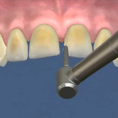 Як сточуються зуби під вініри